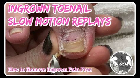 Pedicure Tutorial How To Remove Ingrown Toenail Satisfying Slow Motion ⭐ Youtube