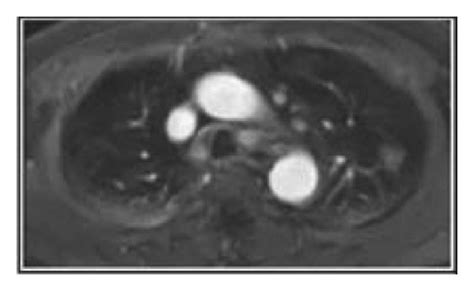 Mri Features Of Different Types Of Lung Nodules A Pulmonary Nodule