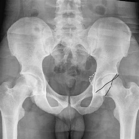 On An Anteroposterior Pelvic Radiograph The Presence Of A Prominent