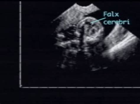 Hydranencephaly Ultrasoundpaedia