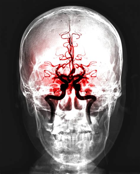 Blood clot in my brain almost ended my life. - Capitol Rehab of Arlington