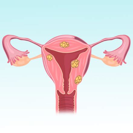 Qué es un Mioma Uterino Causas Síntomas Diagnóstico y Tratamiento