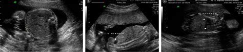 Antenatal Sonography Color Doppler