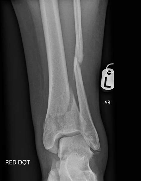 Tibial Fractures Plateau Shaft And Pilon Orthosho