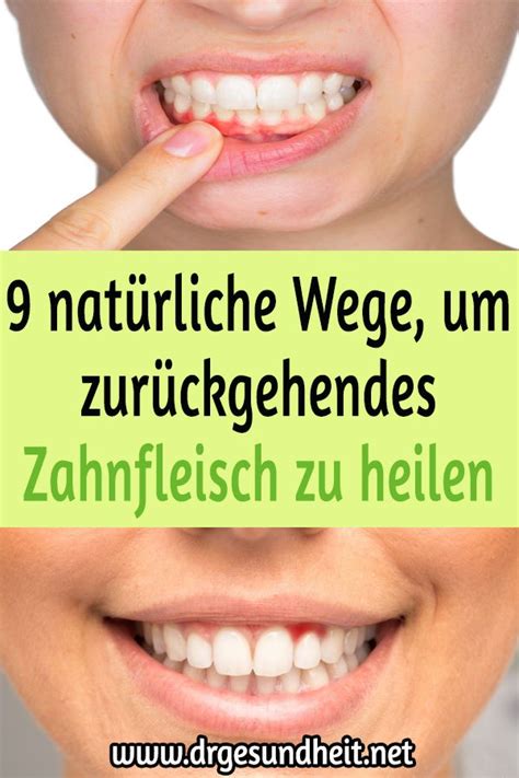 Nat Rliche Wege Um Zur Ckgehendes Zahnfleisch Zu Heilen Zahnfleisch