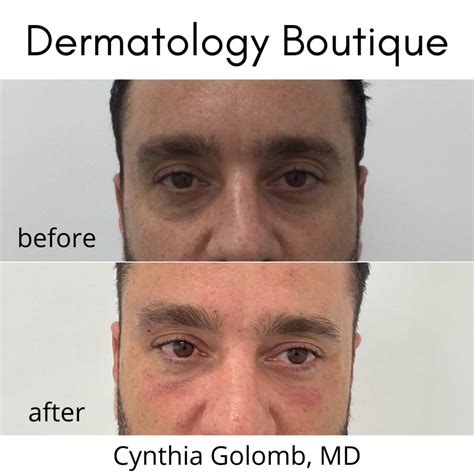 Under Eye Rejuvenation Cynthia Golomb MD Dermatology Boutique