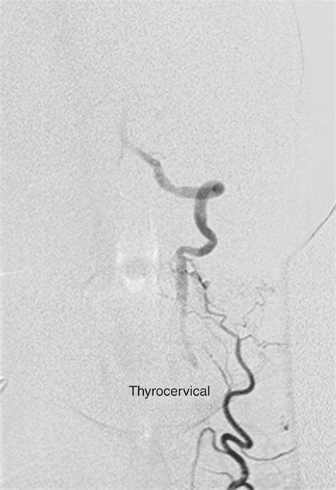 Vertebral Artery Dissection And Other Conditions Clinical Tree