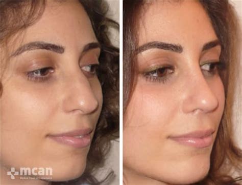 Rhinoplasty Turkey All Inclusive Nose Job In Turkey Cost