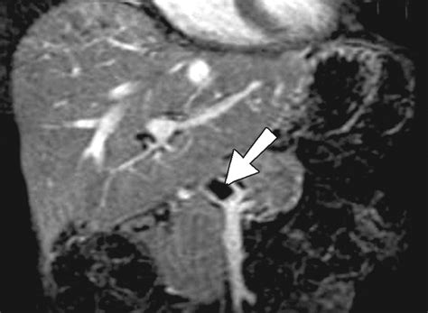 Postoperative Imaging In Liver Transplantation What Radiologists