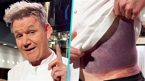 Gordon Ramsay Reveals Massive Bruise After Scary Bike Accident Lucky