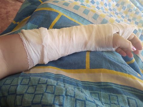 Жжение и боль после перелома кисти руки - Вопрос ортопеду-травматологу ...