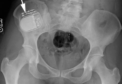 Implantable Electronic Stimulation Devices From Head To Sacrum Imaging Features And Functions