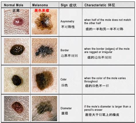 痣也可能会癌变，什么样的痣需要尽早切除？这5种要小心！ 知乎