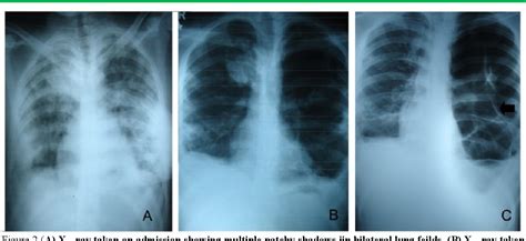 Figure 2 From A Case Series Of Necrotizing Pneumonia Due To Community