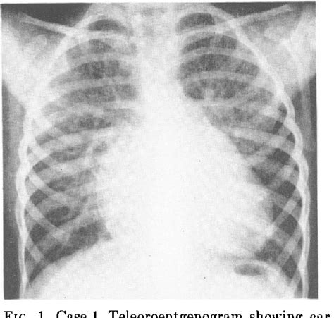 Figure 1 from Syndrome of Left Ventricular‐Right Atrial Shunt Resulting ...