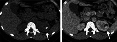 A 35 Year Old Female Who Presented Initially With Flank Pain And