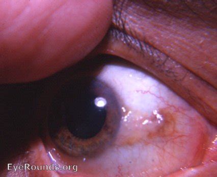 Pinguecula. EyeRounds.org: Online Ophthalmic Atlas