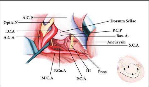 Figure 1 From Morphometry Of The Posterior Clinoid Process And Dorsum Sel Lae Morfometrie Proces