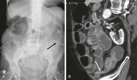 Preoperative And Palliative Colonic Stenting Radiology Key