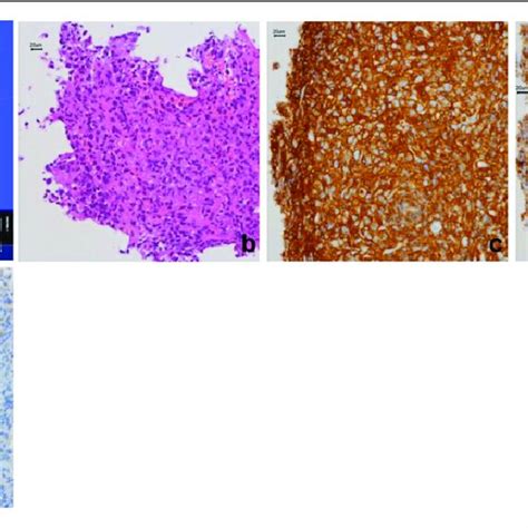 Histologic Findings Of The Tumor The Resected Specimen Measuring