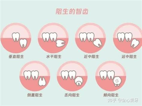 廉江牙科｜智齿到底该不该拔除？ 知乎