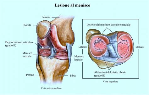 Lesione Al Menisco Sintomi E Cause Esami E Risonanza Magnetica