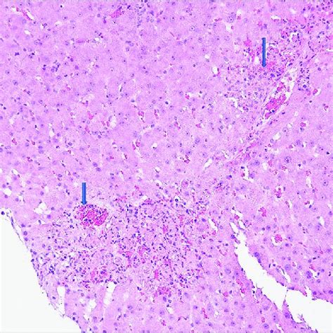 Adenovirus Hepatitis Low Power View Of The Liver Biopsy Shows Download Scientific Diagram