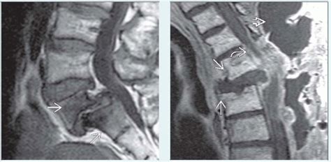 Grade 2 Anterolisthesis