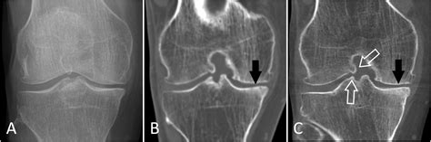 Three Dimensional Analysis For Quantification Of Knee Joint Space Width