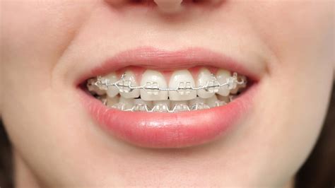 Conoces los diferentes tipos de brackets Clínica Faus