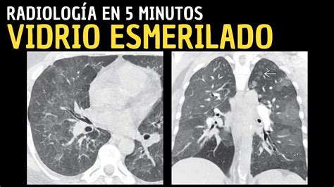 Radiolog A En Minutos Signos Radiol Gicos Pulmonares Vidrio