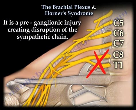 The Brachial Plexus And Horners Syndrome Nabil Ebraheim Medium