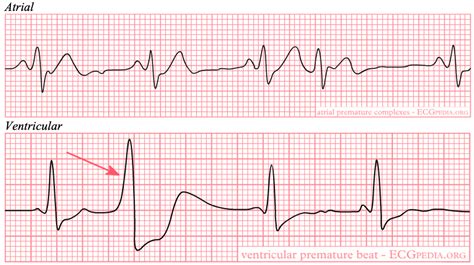 Ecg Interpretation Rate Rhythm Cardiac Axis Teachmepaeds