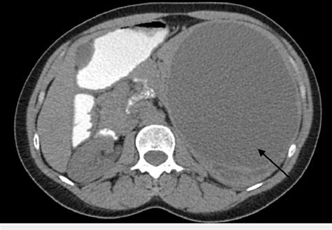 Abdominal Ct Scan Illustrating The Cystic Mass With Several Posterior