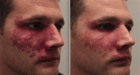 Hemangioma No Rosto Adulto