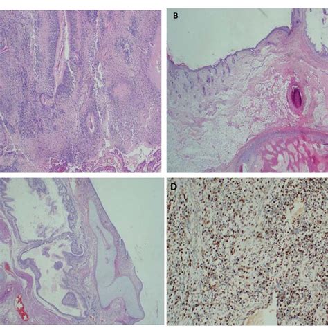 Histopathology Of The Immature Ovarian Teratoma Demonstrating Both