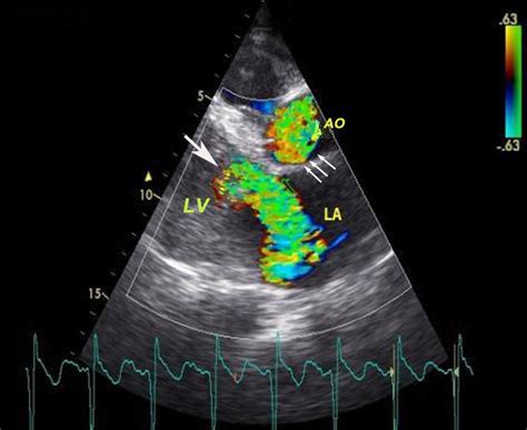 Parasternal long axis transthoracic echocardiography image at end ...