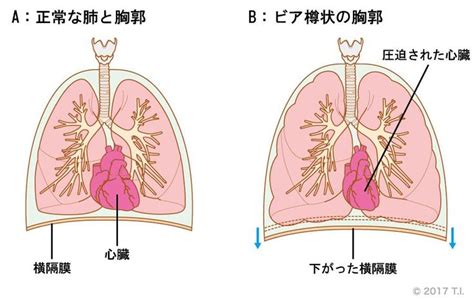 慢性閉塞性肺疾患COPDの疾患解説 看護roo カンゴルー 看護 疾患 閉塞