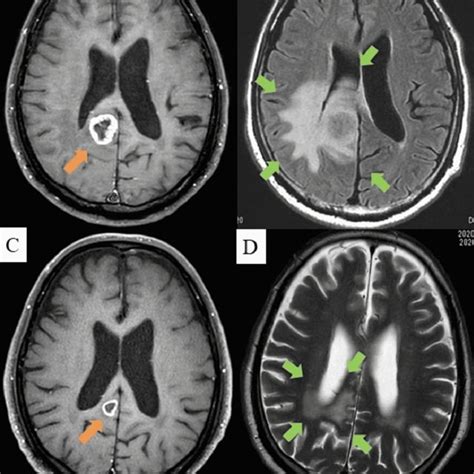 Magnetic Resonance Image Of Brain A Contrast Enhanced Magnetic