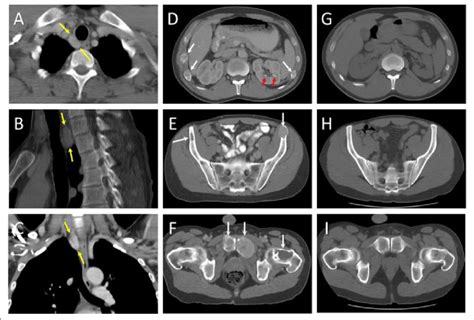 Axial And Sagittal Computed Tomography Ct At Presentation A F With Download Scientific