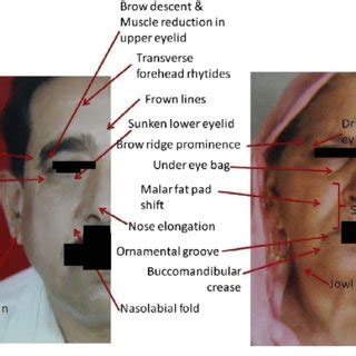 Showing Morphological Age Related Changes In Individuals Belonging To