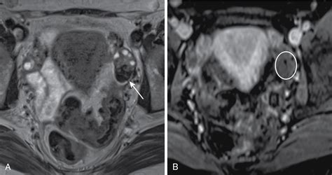 Solid Adnexal Lesions Radiology Key