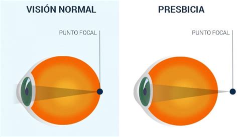 El Tratamiento De Presbicia Top Doctors