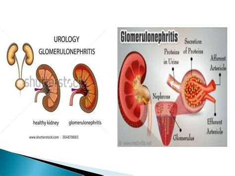 Acute Glomerulonephritis Agn Ppt