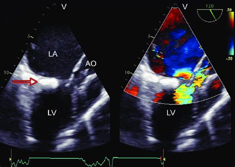 Mid Esophageal Aortic Valve Long Axis View In Transesophageal