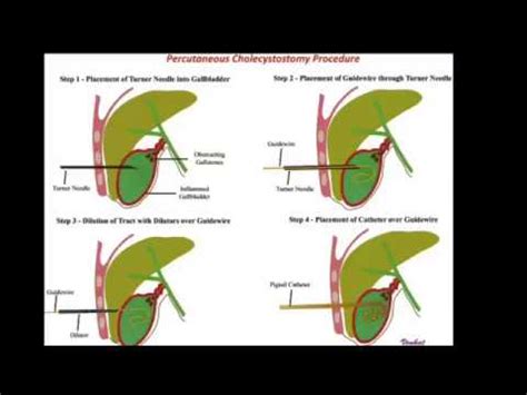 cholecystostomy: percutaneous Gall bladder catheter drainage ...