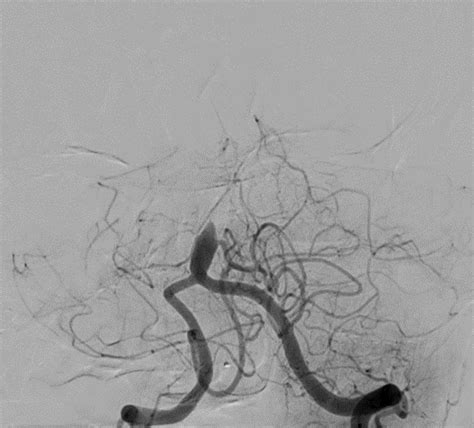 Basilar Artery Occlusion With Thrombectomy And Angioplasty