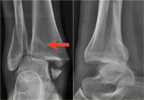 Icd 10 Code For Right Distal Fibula Fracture