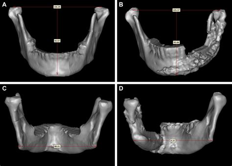 Translating Computer Aided Design And Surgical Planning Into Successful Mandibular