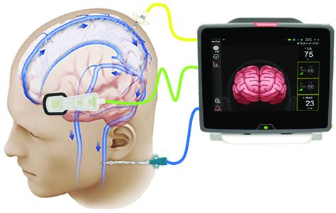 Nirs Derived Regional Tissue Oxygen Saturation Green Probe Analyzes